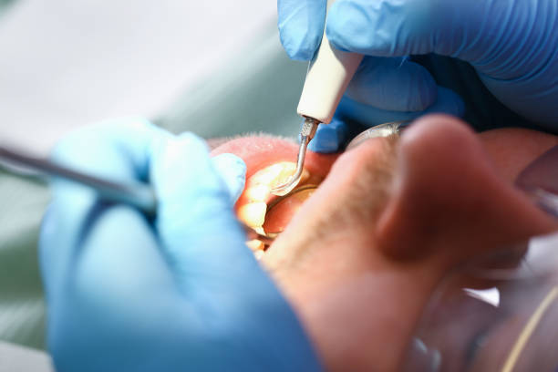 Best Emergency Tooth Extraction in Trenton, TN